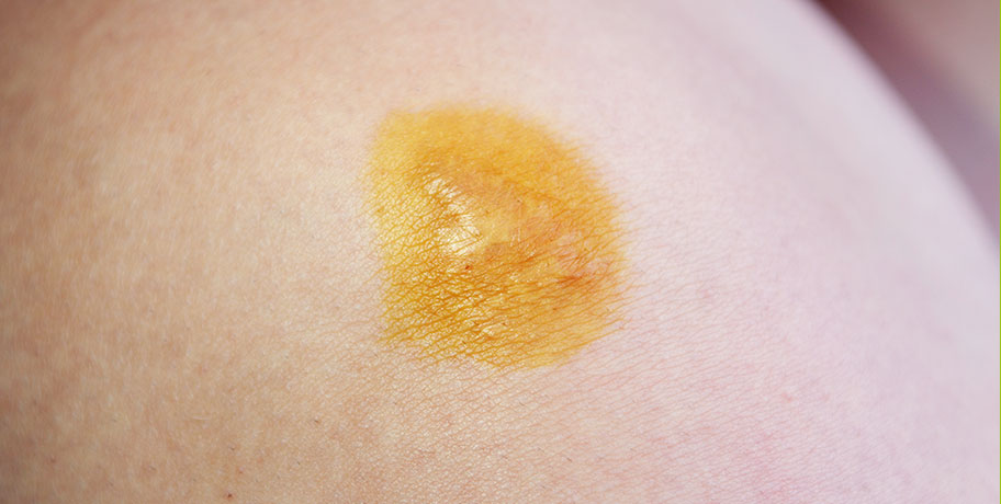 Test skórny z jodem